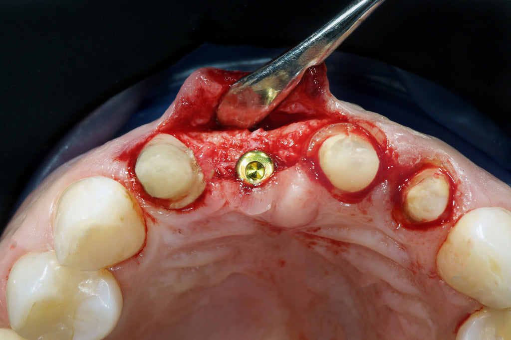 The Importance Of Dental Suturing: Improving Outcome