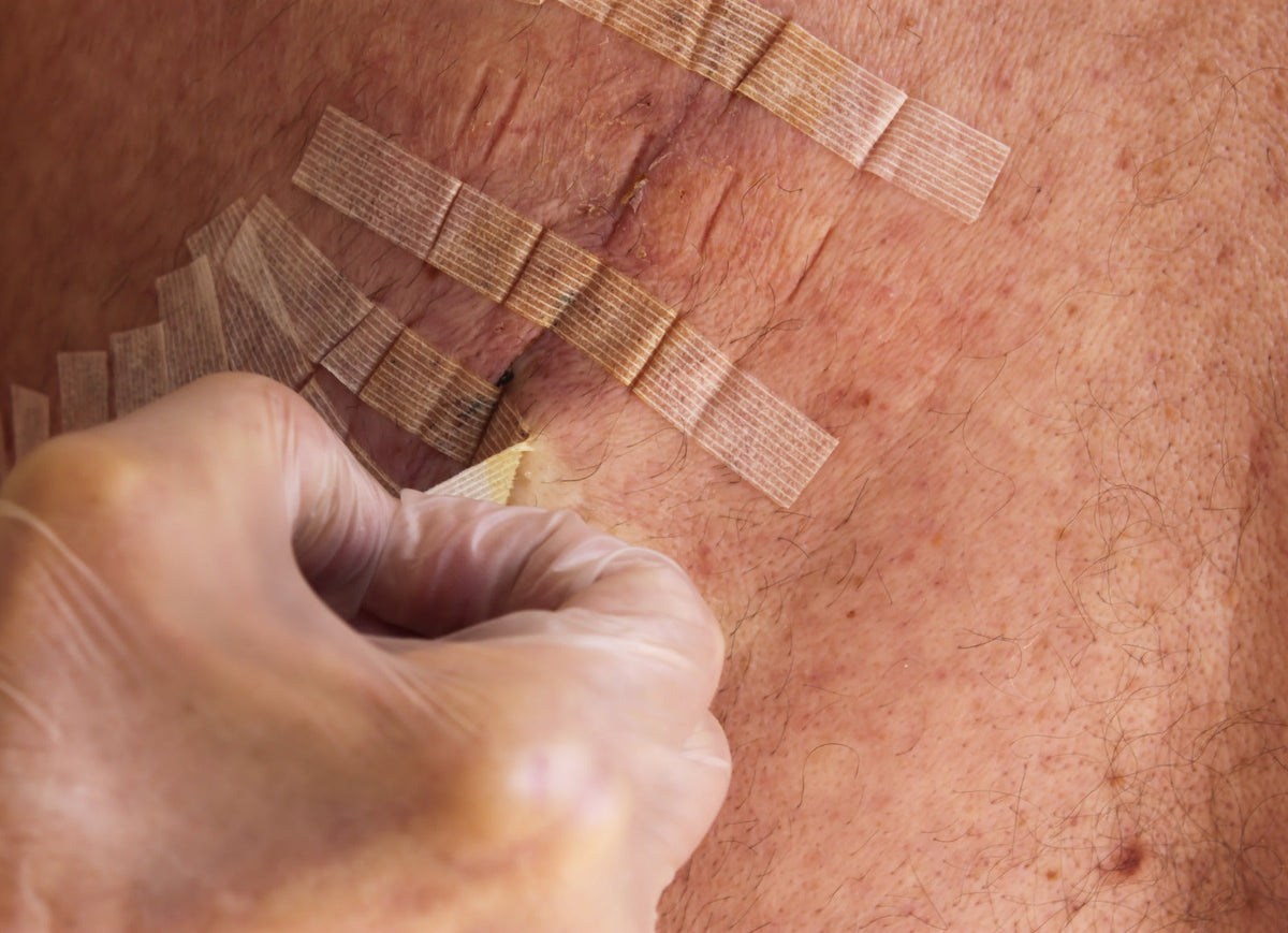Curing Stripes When And How To Use 3M Steri-Strips For Different Types Of Wounds